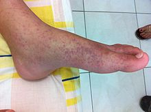 Chikungunya rash on a foot – Best Places In The World To Retire – International Living