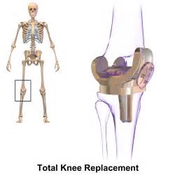 Knee replacement – Best Places In The World To Retire – International Living
